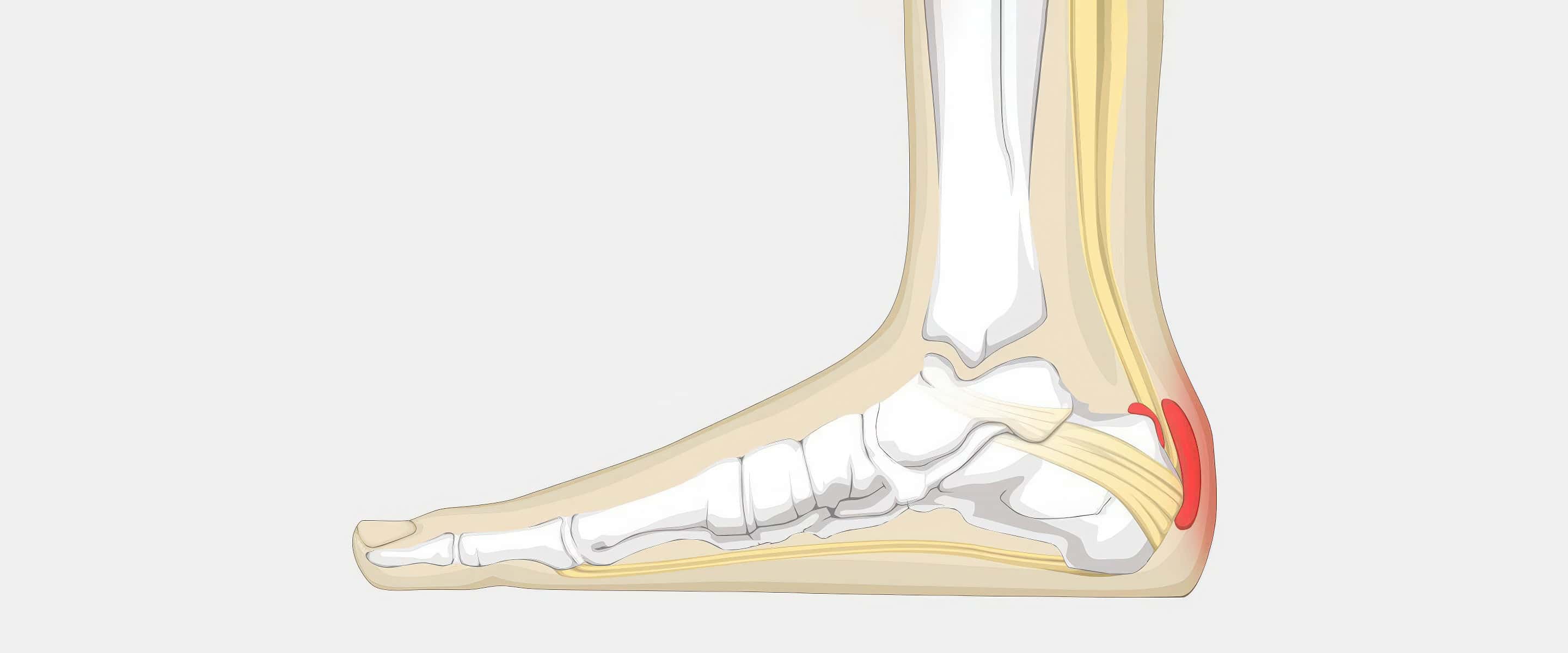 Achilles Bursitis - The Complete Injury Guide — Vive Health