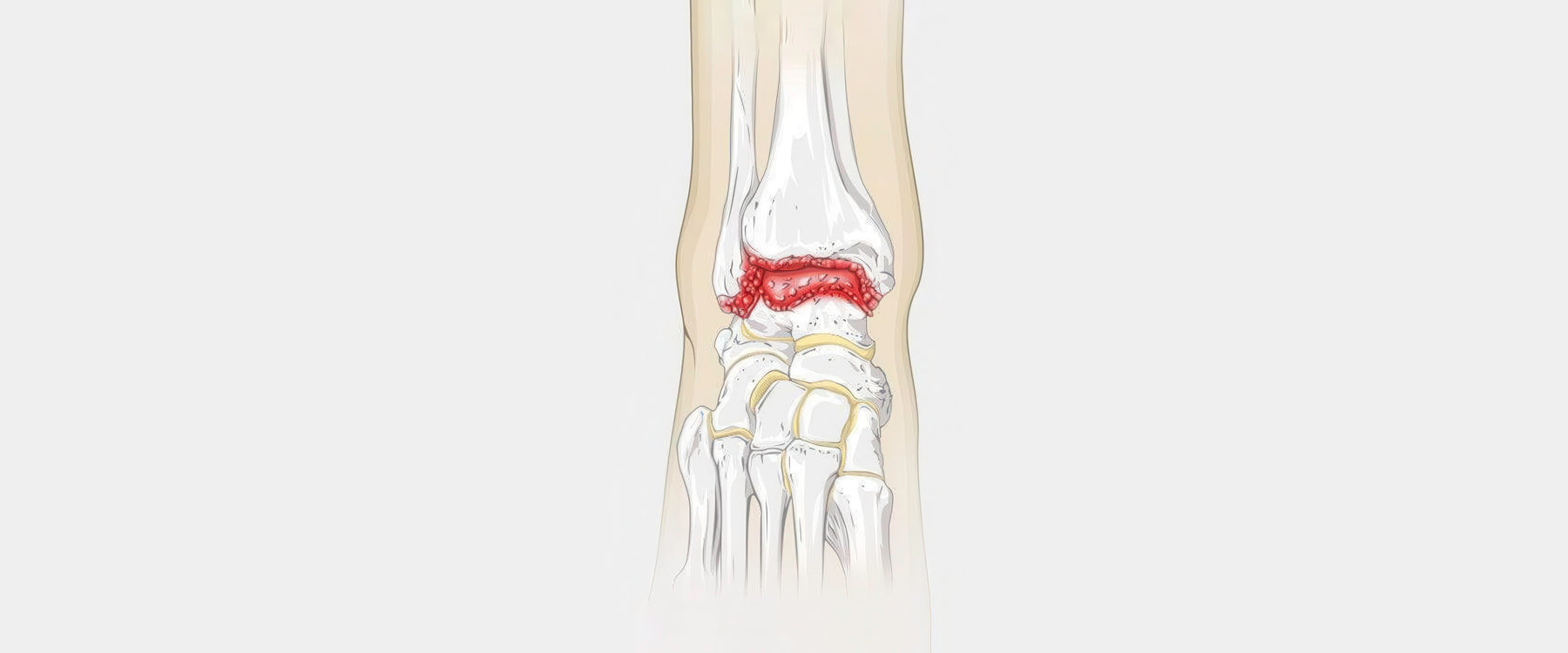 Ankle Arthritis Illustration