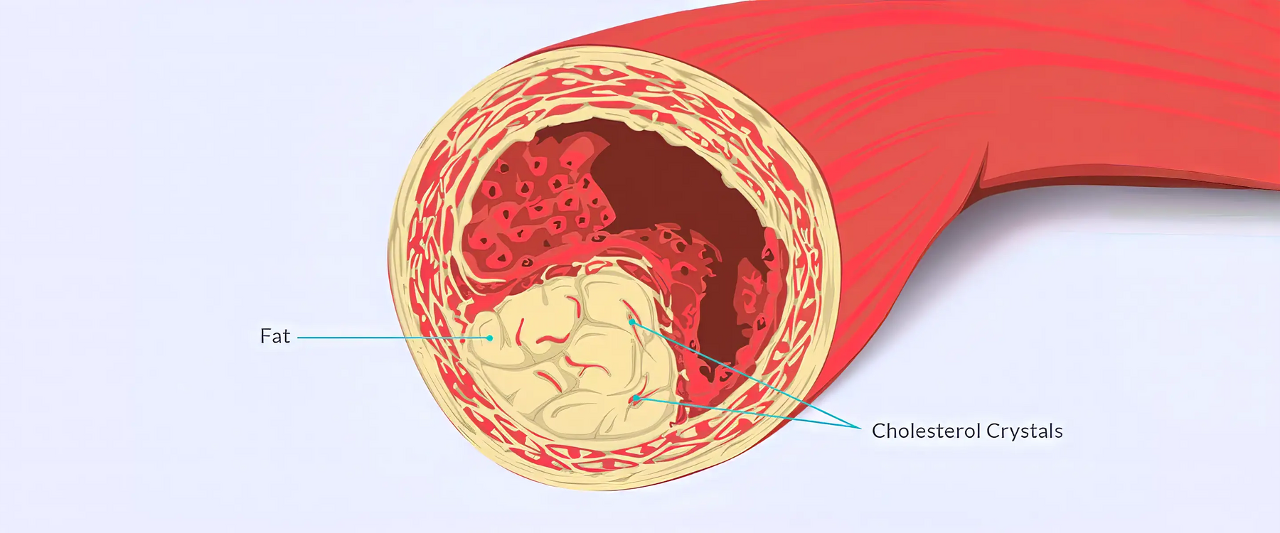 Cholesterol filled artery Illustration