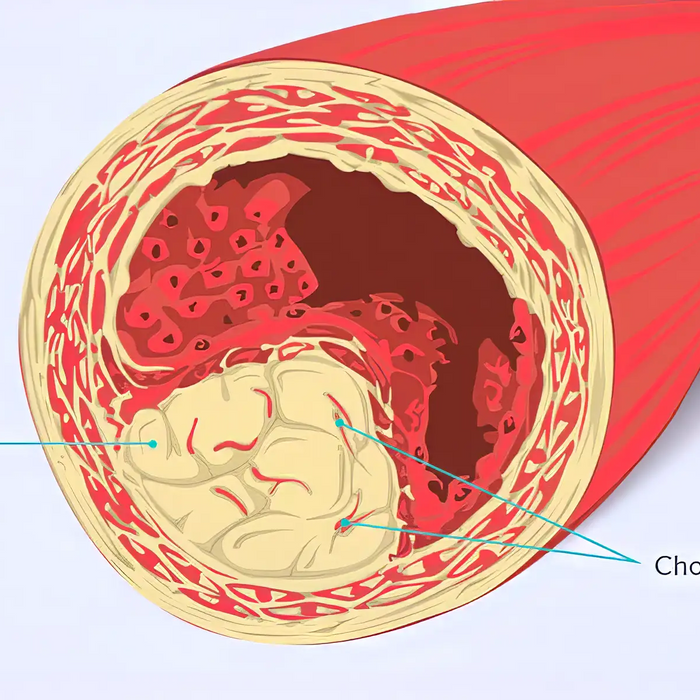 Cholesterol filled artery Illustration