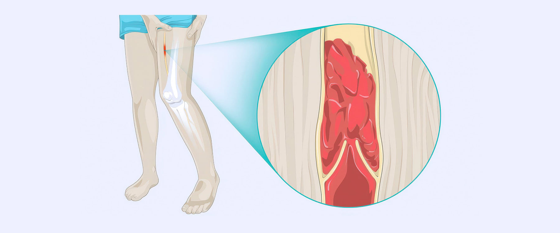 DVT Diagram