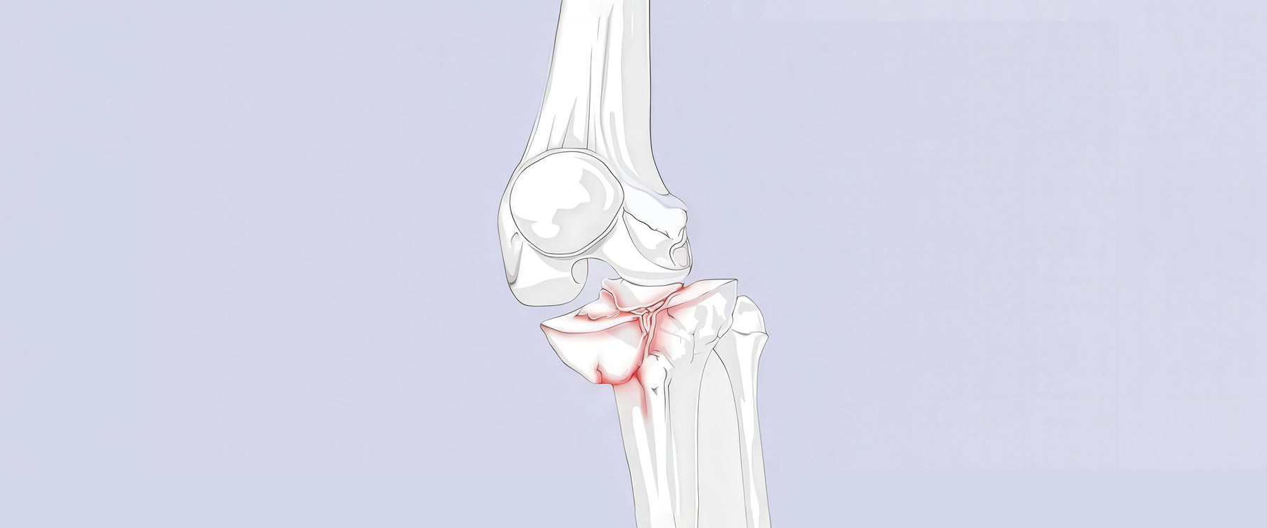 Fractured Knee Illustration