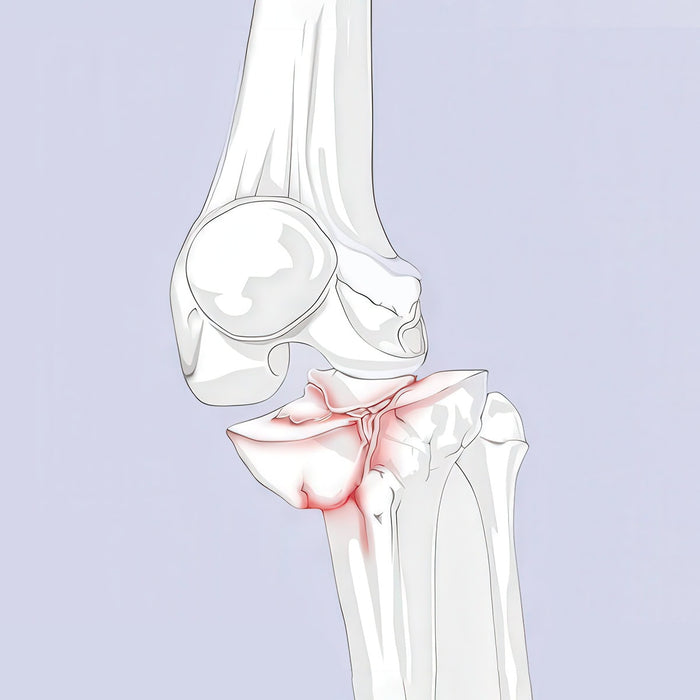 Fractured Knee Illustration