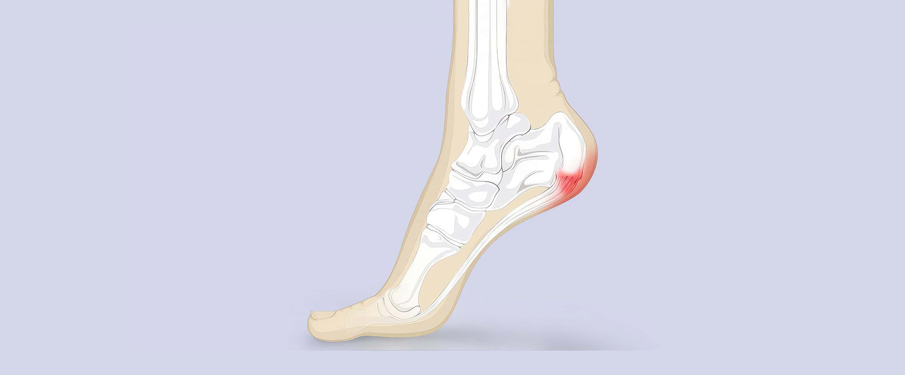 Heel Pain Illustration