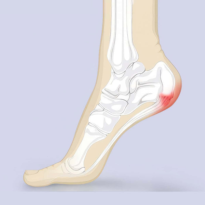 Heel Pain Illustration