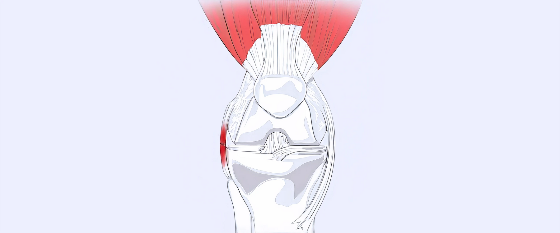 LCL Tear Illustration