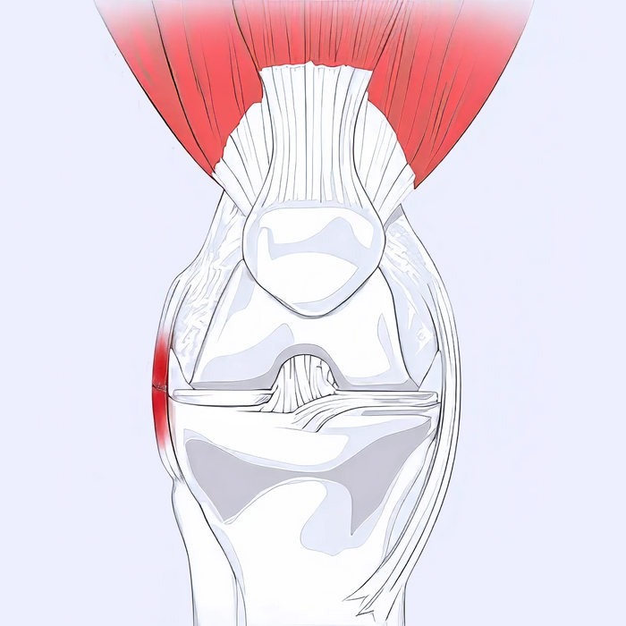 LCL Tear Illustration