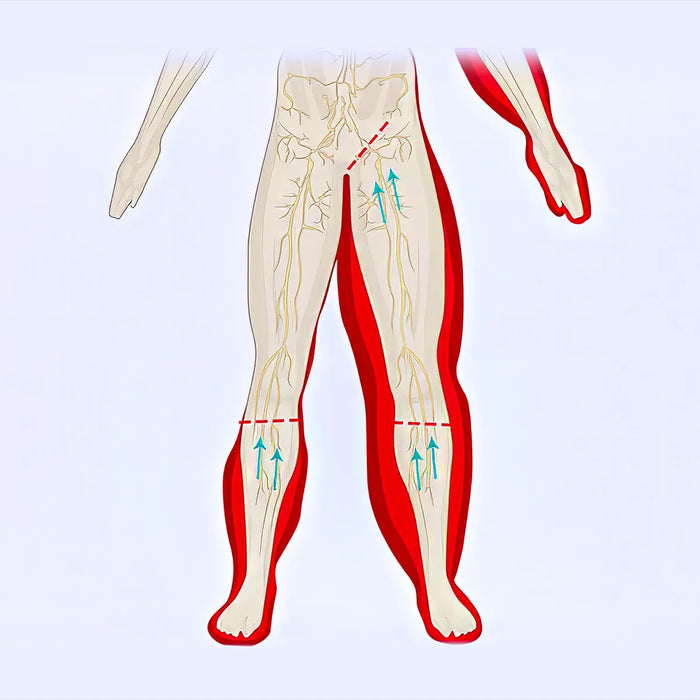 Lymphedema Diagram