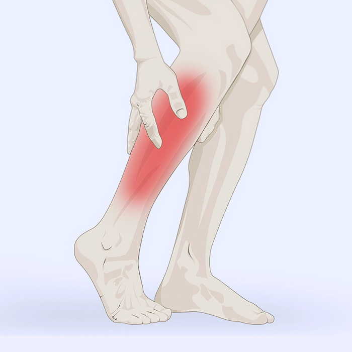 Muscle Cramps Illustration