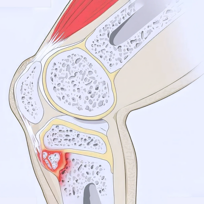 Osgood schlatter disease illustration