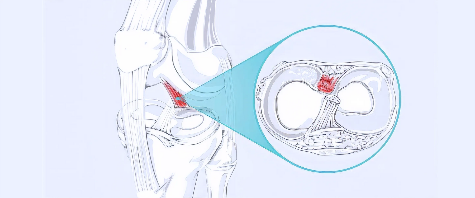 PCL Tear Illustration