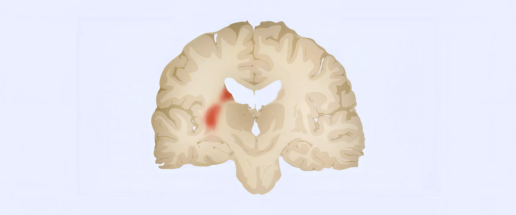 Parkinson’s Disease Illustration