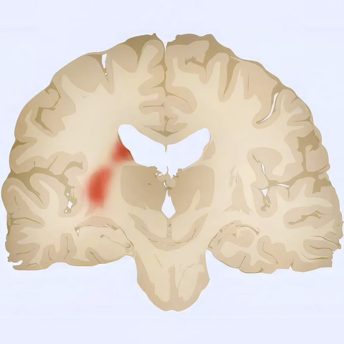 Parkinson’s Disease Illustration