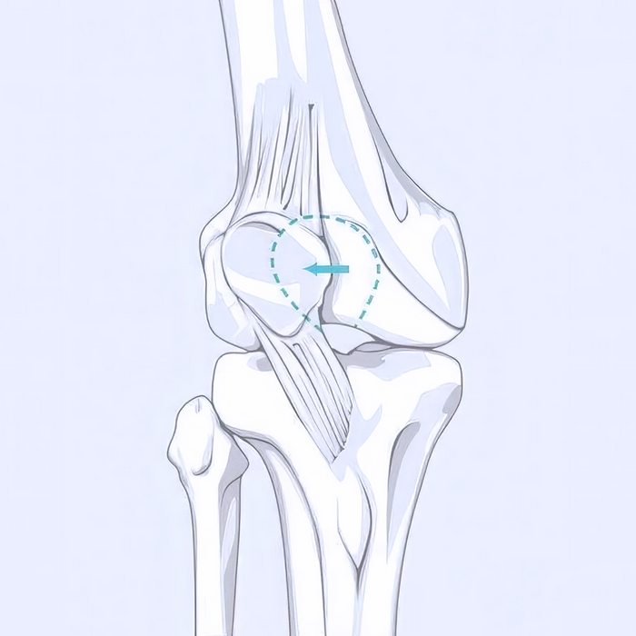 Patellar Dislocation Illustration