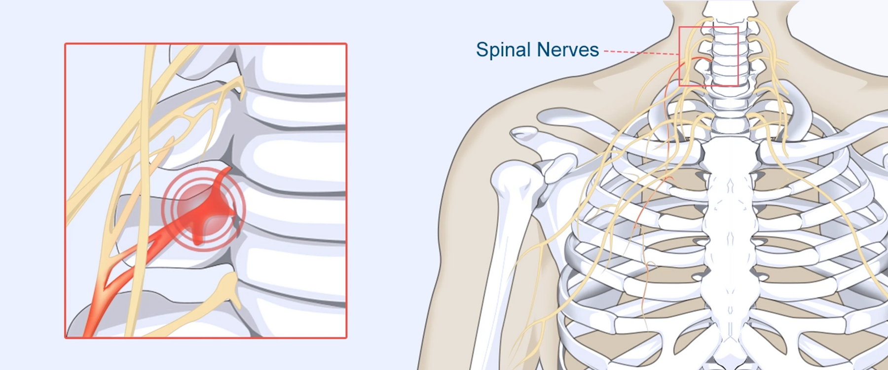 Pinched-Nerve-Diagram