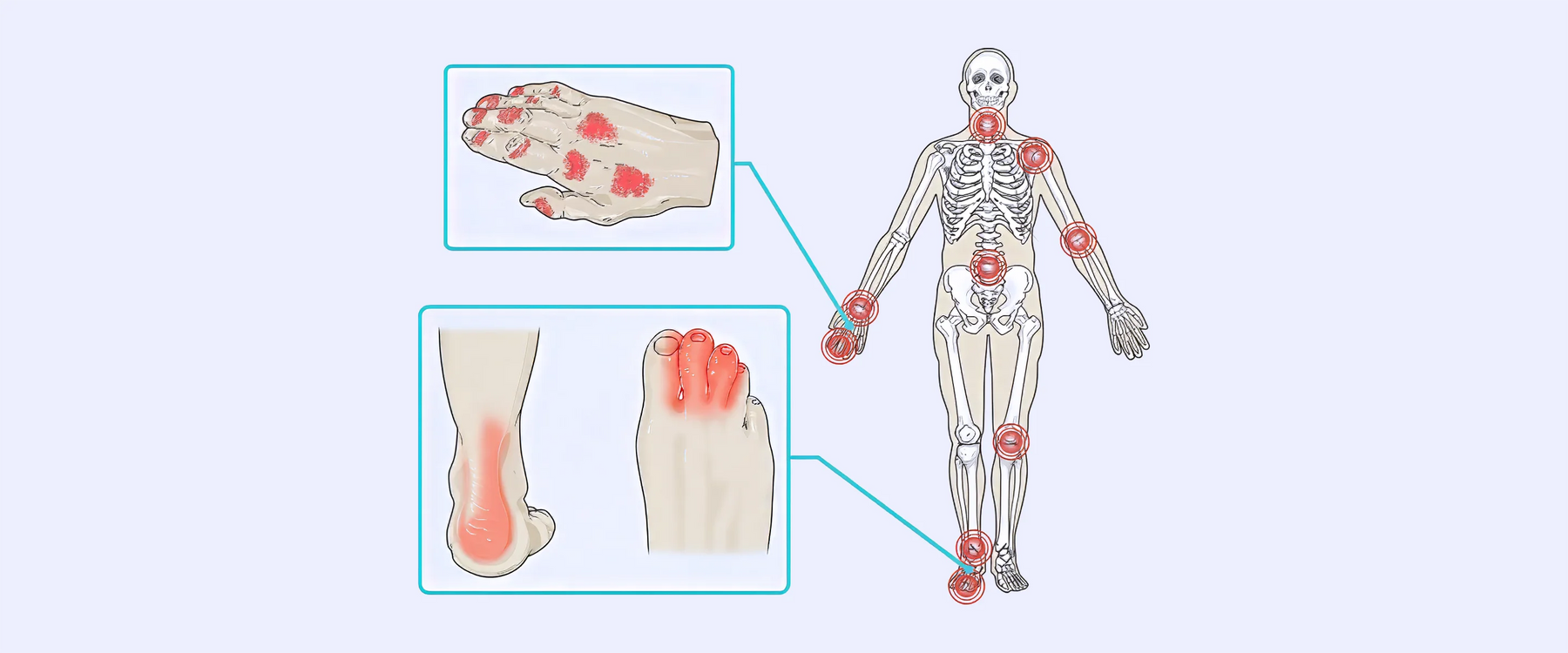 Psoriatic Arthritis – The Complete Injury Guide