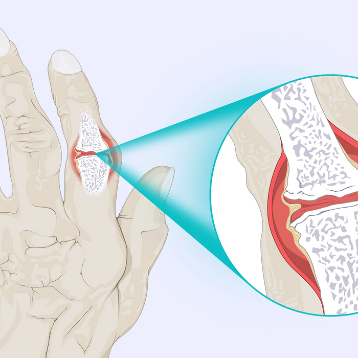 Rheumatoid Arthritis Illustration