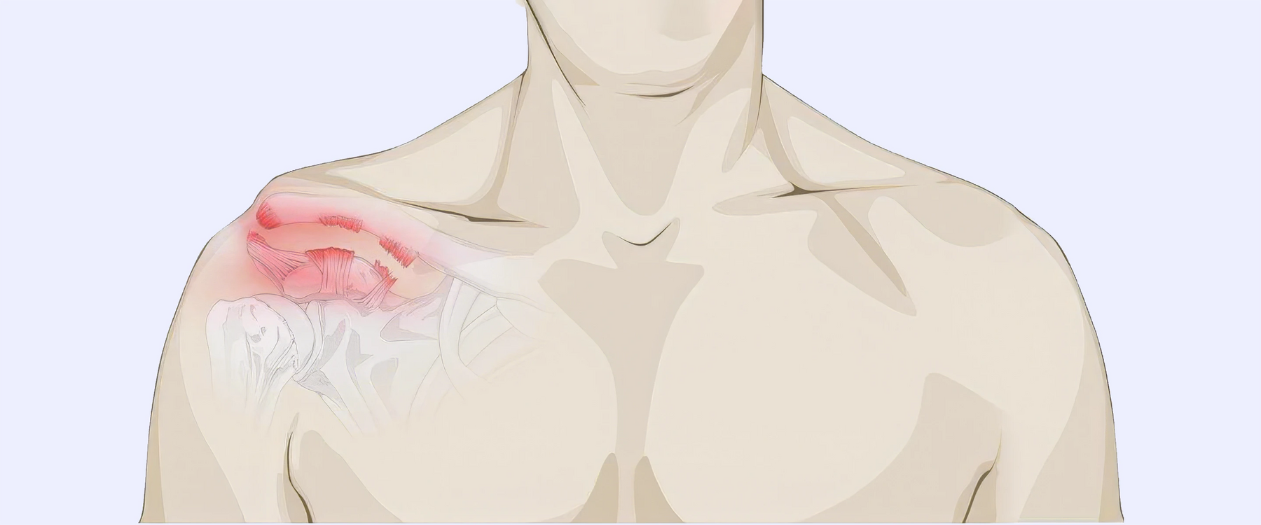 Shoulder separation illustration