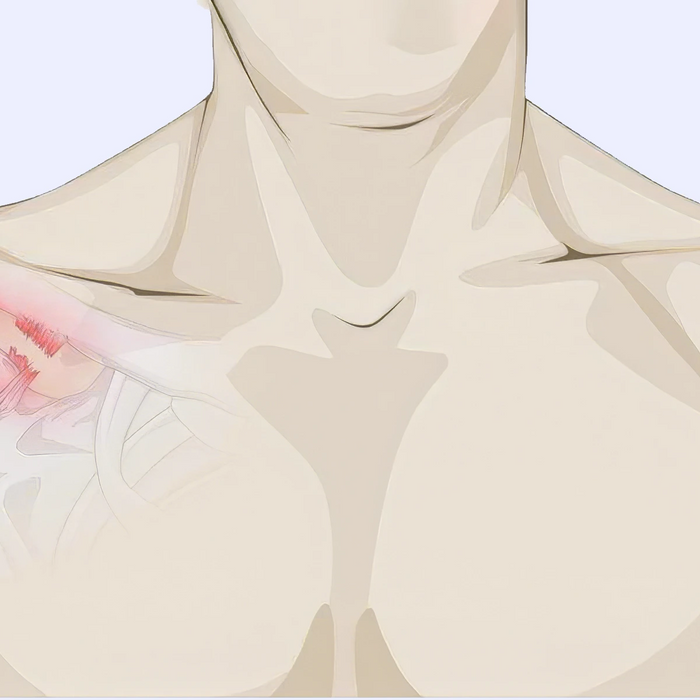 Shoulder separation illustration