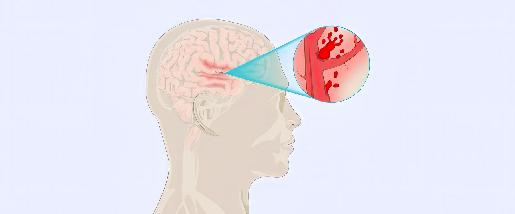 Vascular Dementia Illustration