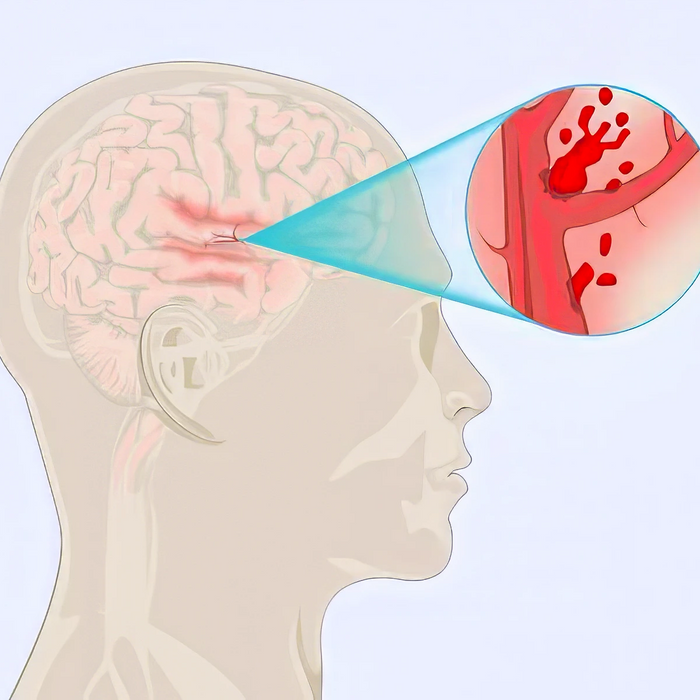 Vascular Dementia Illustration